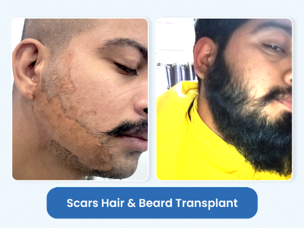 Scar Hair Transplant in Nepal – Everything You Should Know